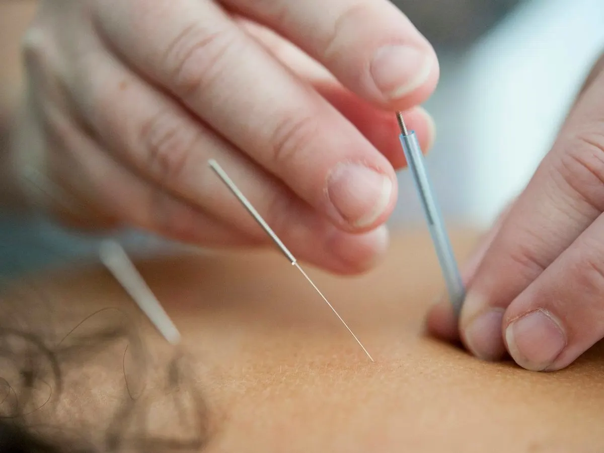Thin needles placed in the skin during treatment